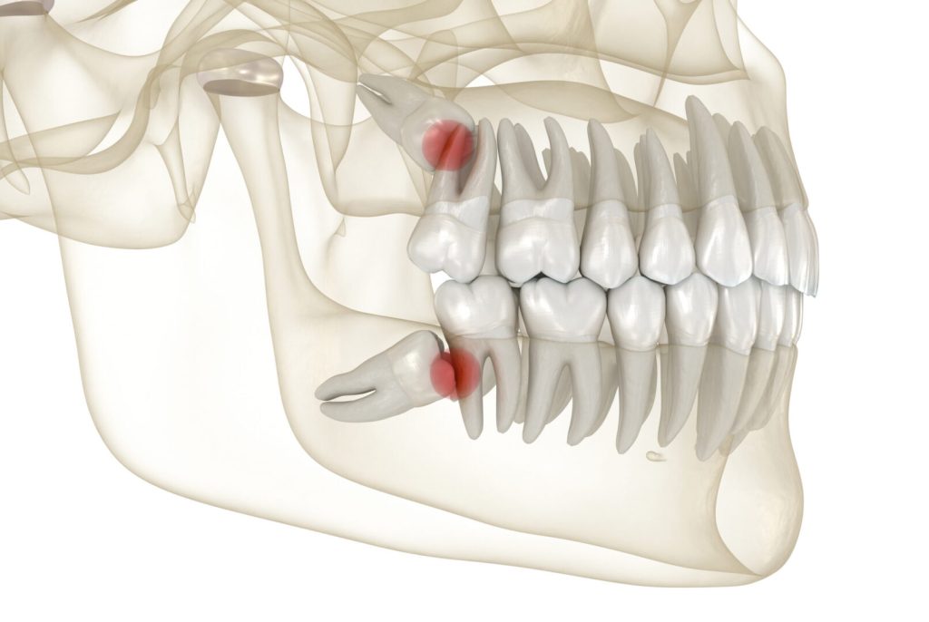 Wisdom teeth removal