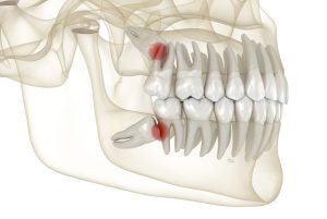 Wisdom teeth removal